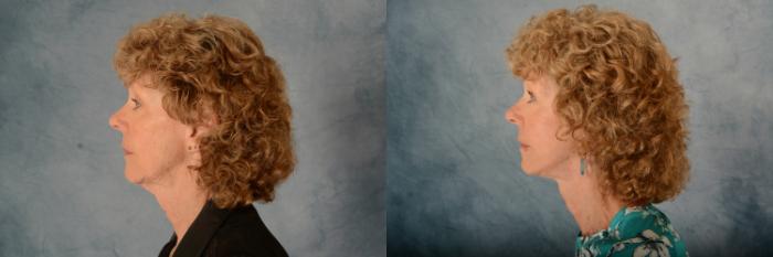 Before & After Facelift Case 632 Left Side View in Tallahassee, FL