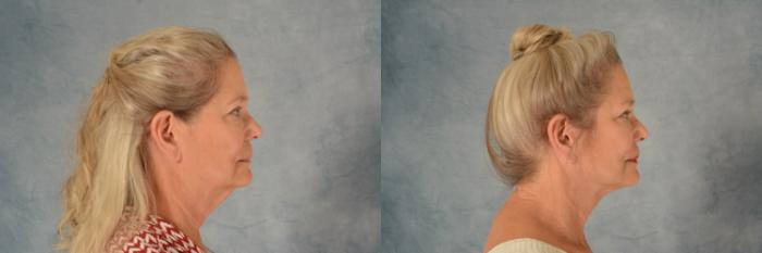 Before & After Facelift Case 633 Right Side View in Tallahassee, FL