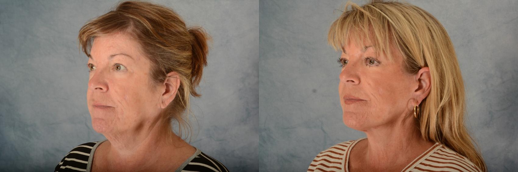 Before & After Facelift Case 662 Left Oblique View in Tallahassee, FL