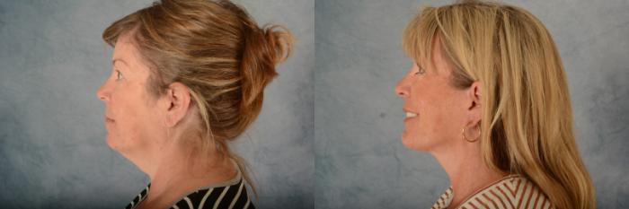 Before & After Facelift Case 662 Left Side View in Tallahassee, FL