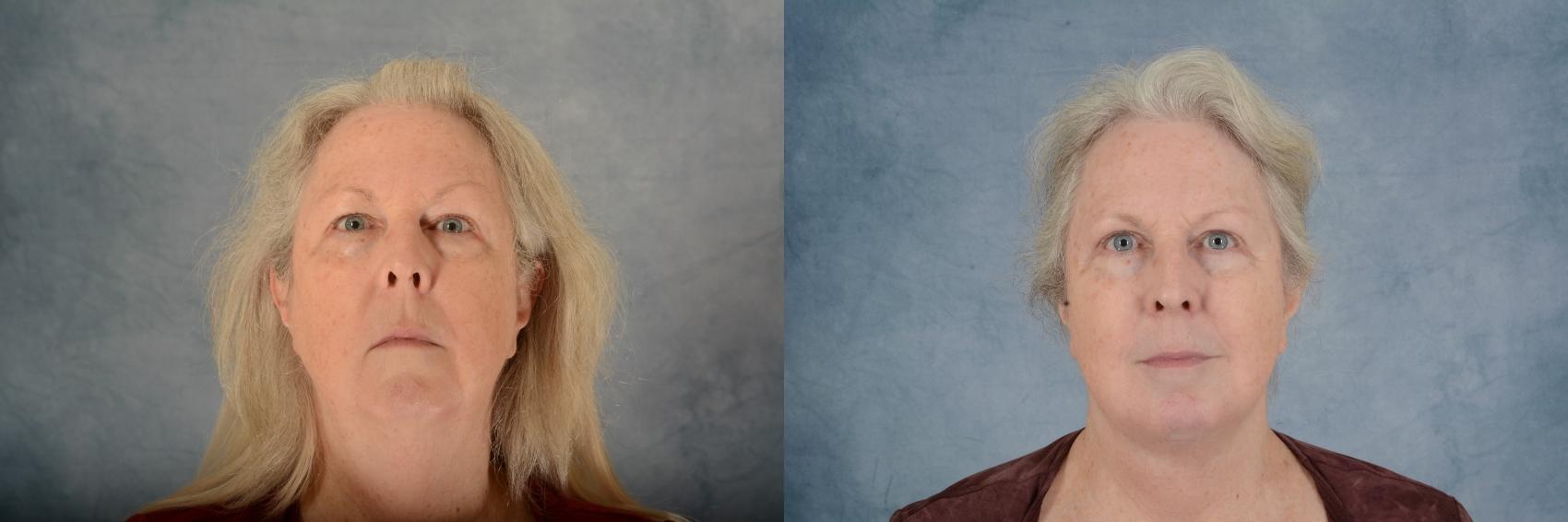 Before & After Facelift Case 670 Front View in Tallahassee, FL