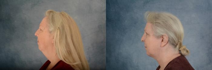 Before & After Facelift Case 670 Left Side View in Tallahassee, FL