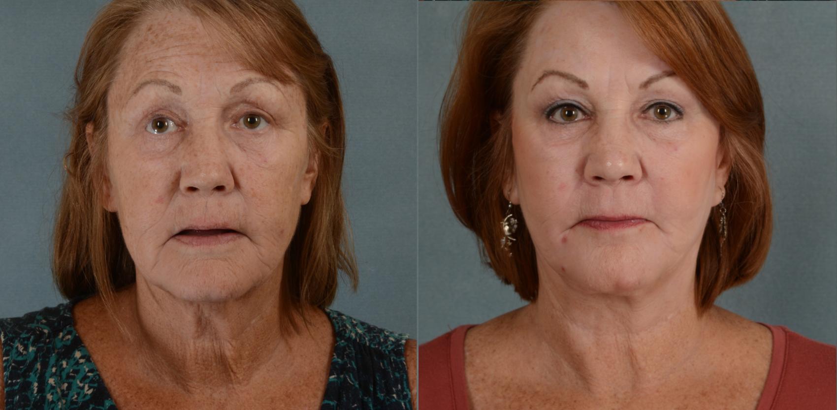 Before & After Facelift Case 678 Front View in Tallahassee, FL