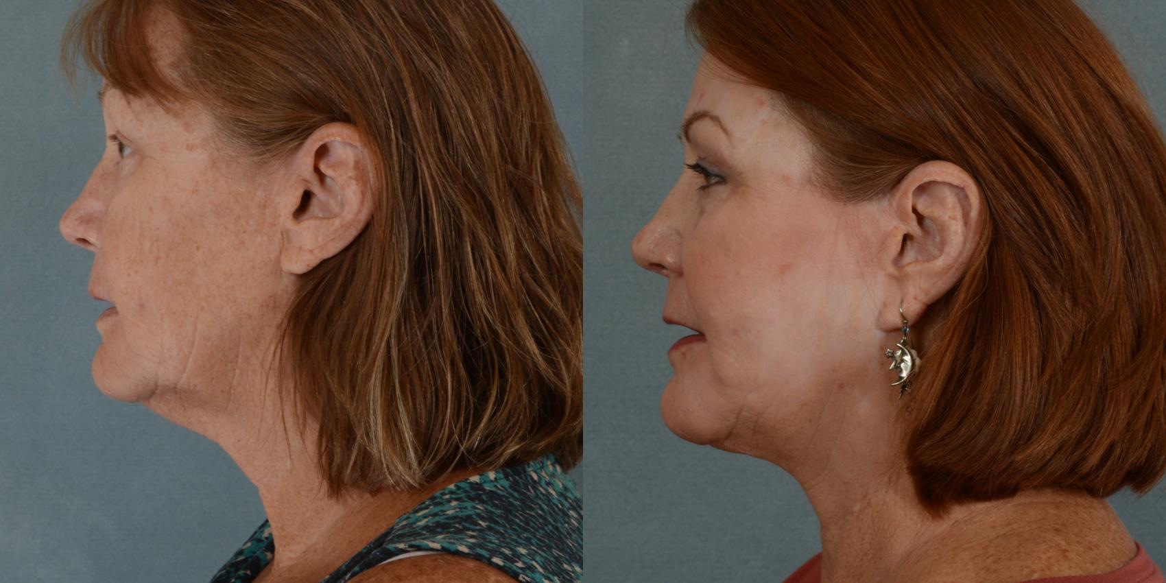 Before & After Facelift Case 678 Left Side View in Tallahassee, FL