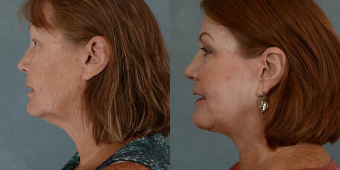 Before & After Facelift Case 678 Left Side View in Tallahassee, FL