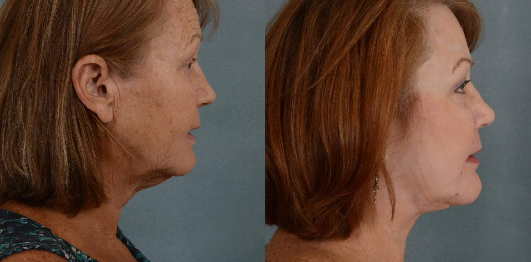 Before & After Facelift Case 678 Right Side View in Tallahassee, FL