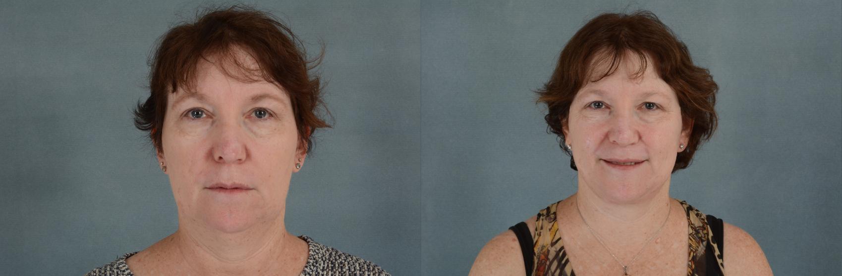 Before & After Facelift Case 679 Front View in Tallahassee, FL