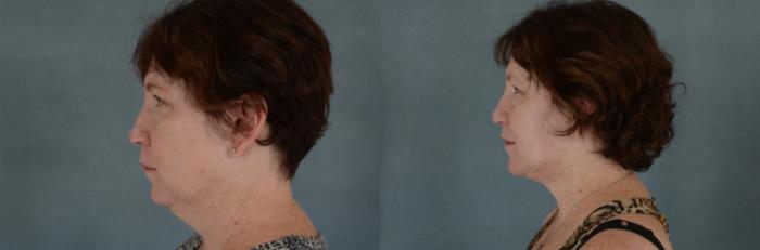 Before & After Facelift Case 679 Left Side View in Tallahassee, FL