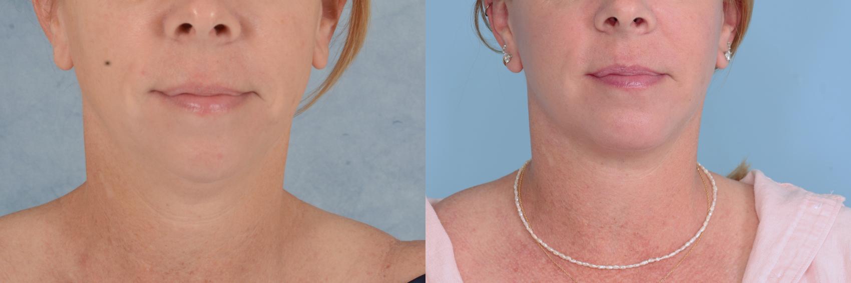 Before & After Facelift Case 731 Front View in Tallahassee, FL