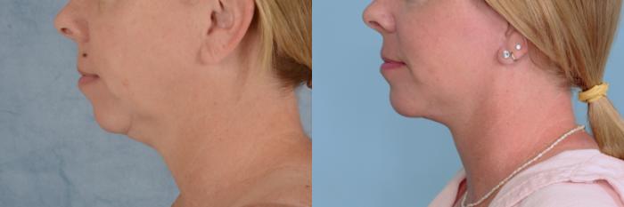 Before & After Facelift Case 731 Left Side View in Tallahassee, FL