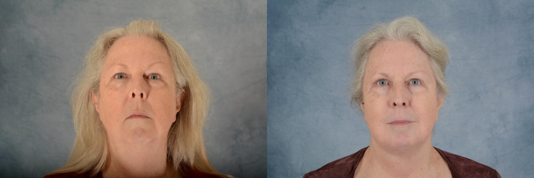 Before & After Facelift Case 734 Front View in Tallahassee, FL