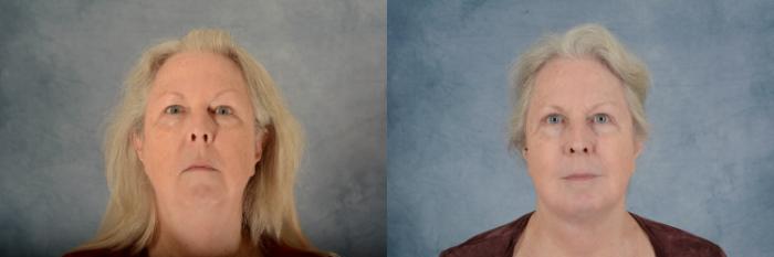 Before & After Facelift Case 734 Front View in Tallahassee, FL