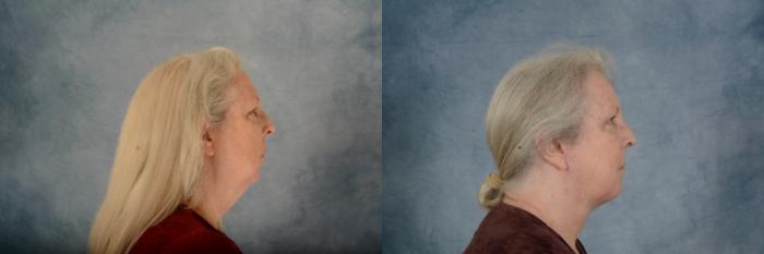 Before & After Facelift Case 734 Right Side View in Tallahassee, FL