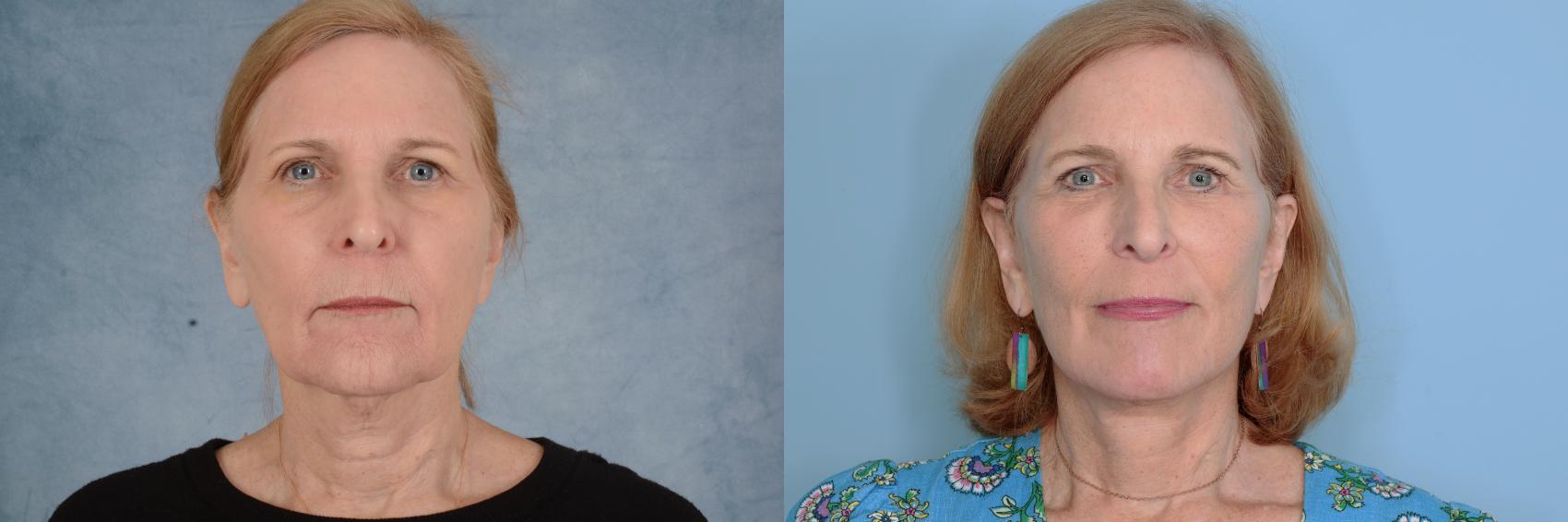 Before & After Facelift Case 753 Front View in Tallahassee, FL