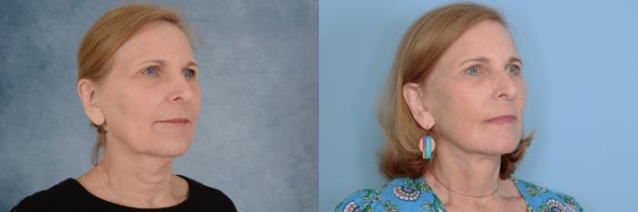 Before & After Facelift Case 753 Right Oblique View in Tallahassee, FL