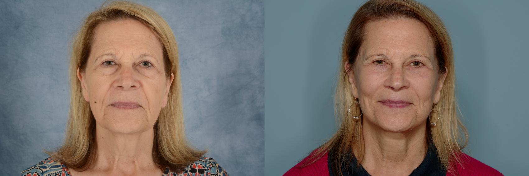 Before & After Facelift Case 761 Front View in Tallahassee, FL