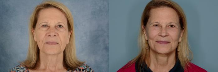 Before & After Facelift Case 761 Front View in Tallahassee, FL