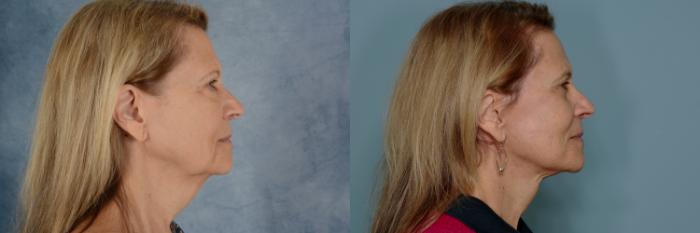 Before & After Facelift Case 761 Right Side View in Tallahassee, FL