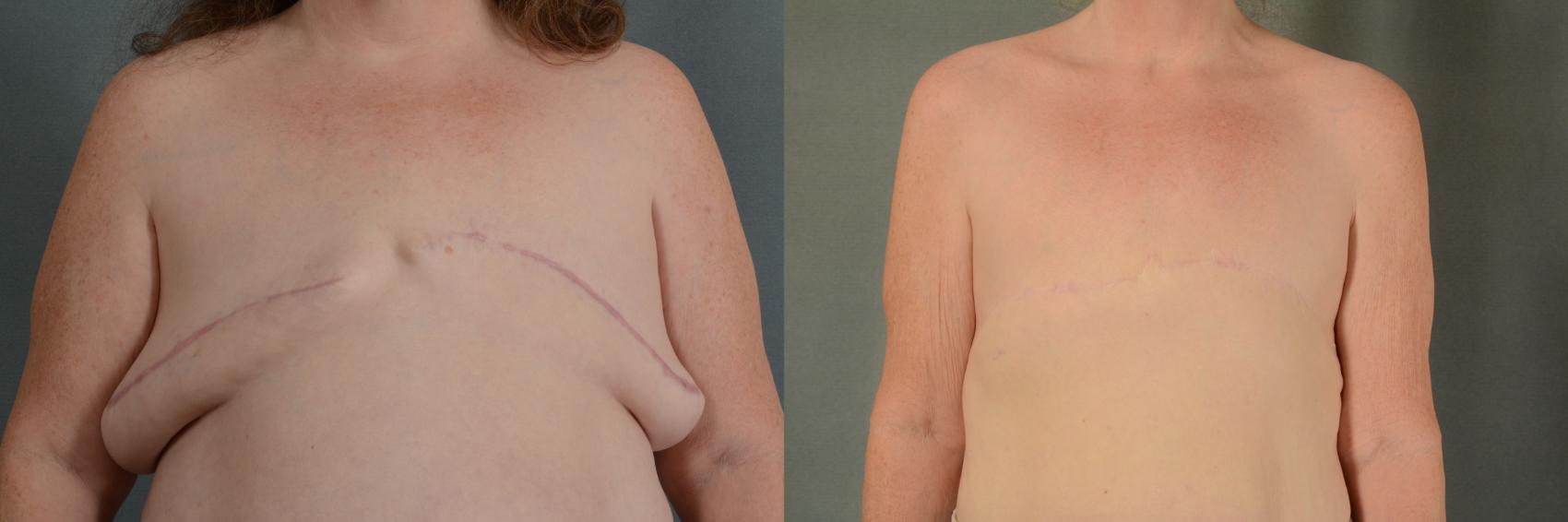 Before & After "Go Flat" after Mastectomy Case 434 View #1 View in Tallahassee, FL