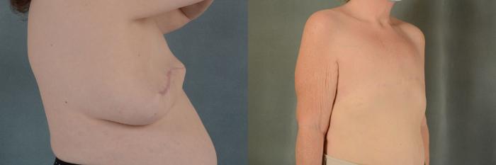 Before & After "Go Flat" after Mastectomy Case 434 View #2 View in Tallahassee, FL