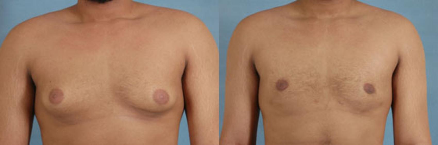 Before & After Gynecomastia (Male Breast Reduction) Case 106 View #1 View in Tallahassee, FL