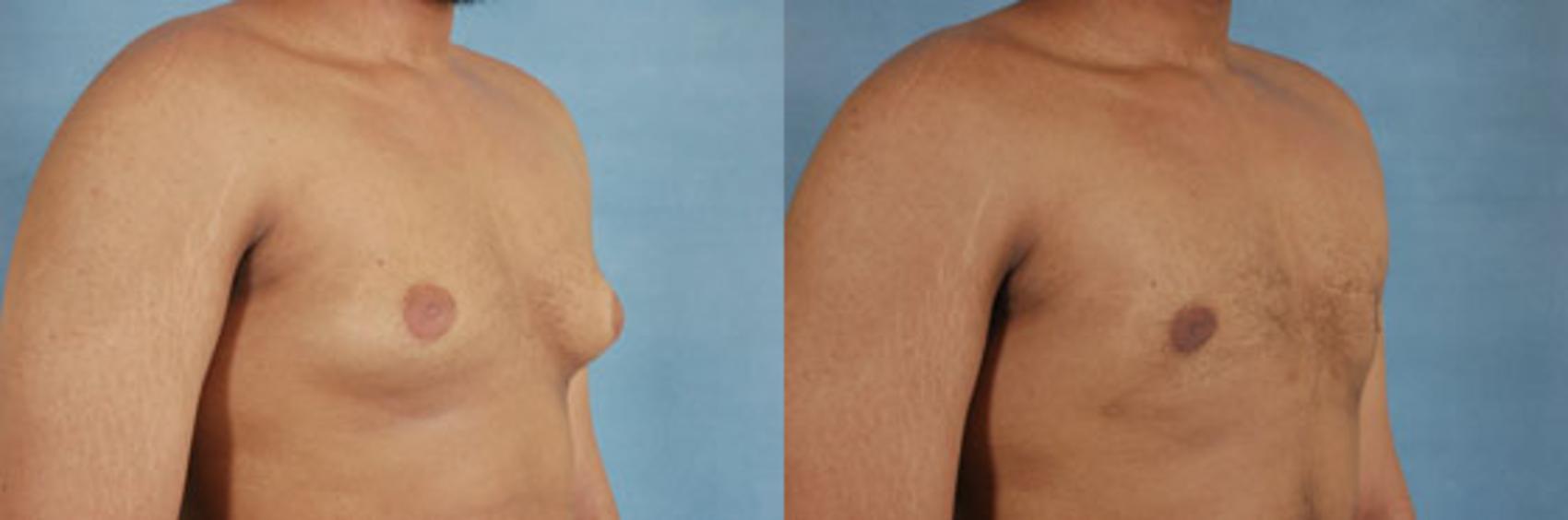 Before & After Gynecomastia (Male Breast Reduction) Case 106 View #2 View in Tallahassee, FL