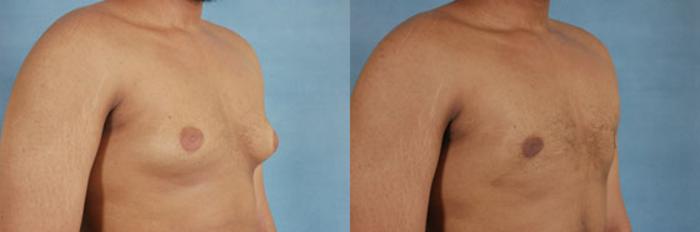 Before & After Gynecomastia (Male Breast Reduction) Case 106 View #2 View in Tallahassee, FL