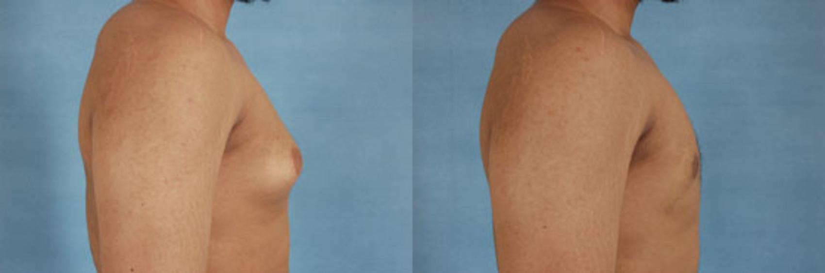 Before & After Gynecomastia (Male Breast Reduction) Case 106 View #3 View in Tallahassee, FL