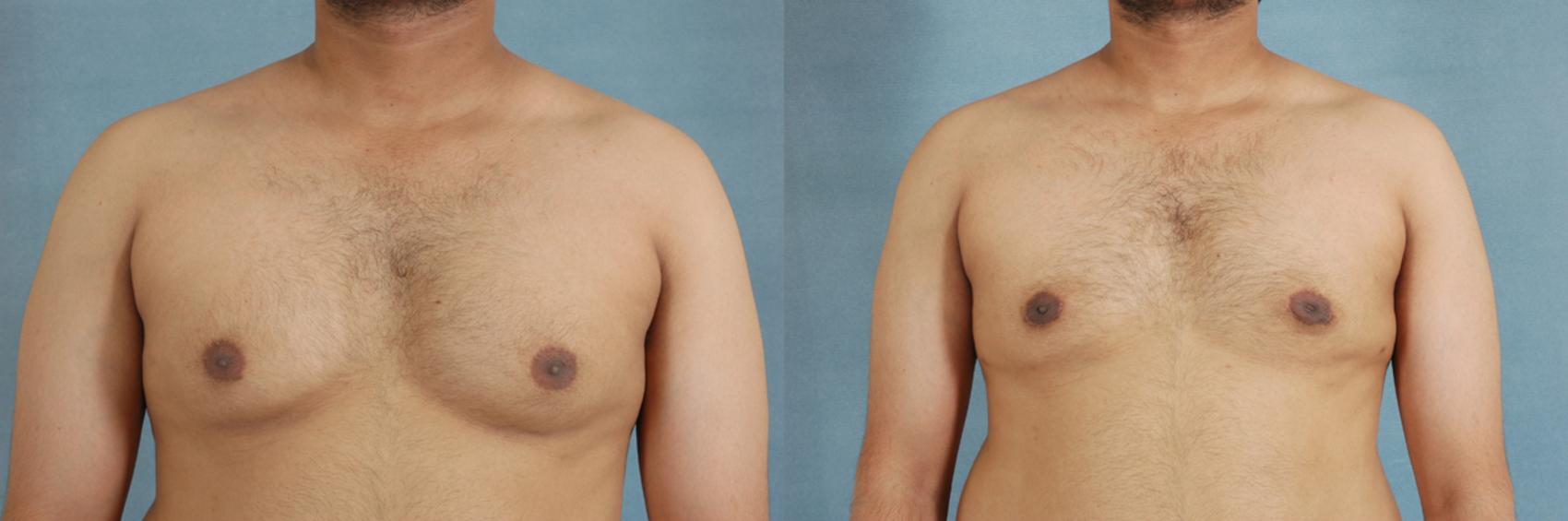 Before & After Gynecomastia (Male Breast Reduction) Case 107 View #1 View in Tallahassee, FL