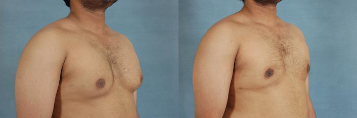 Before & After Gynecomastia (Male Breast Reduction) Case 107 View #2 View in Tallahassee, FL
