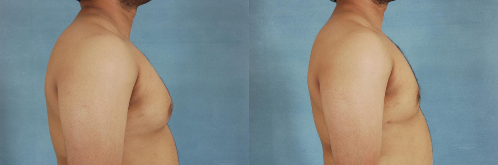 Before & After Gynecomastia (Male Breast Reduction) Case 107 View #3 View in Tallahassee, FL