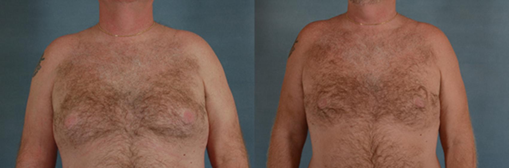 Before & After Gynecomastia (Male Breast Reduction) Case 108 View #1 View in Tallahassee, FL