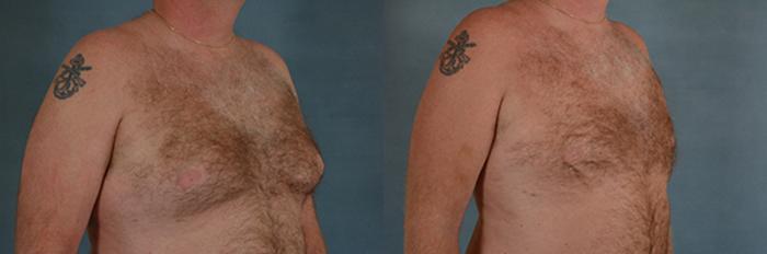 Before & After Gynecomastia (Male Breast Reduction) Case 108 View #2 View in Tallahassee, FL