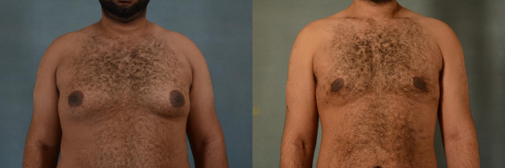 Before & After Gynecomastia (Male Breast Reduction) Case 402 View #1 View in Tallahassee, FL