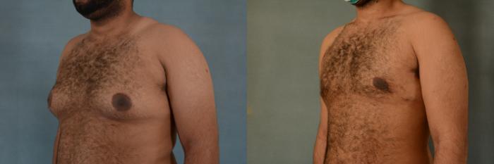 Before & After Gynecomastia (Male Breast Reduction) Case 402 View #2 View in Tallahassee, FL
