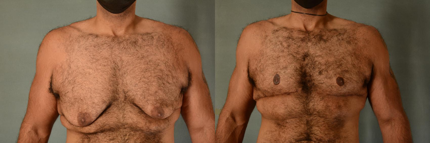 Before & After Gynecomastia (Male Breast Reduction) Case 404 View #1 View in Tallahassee, FL