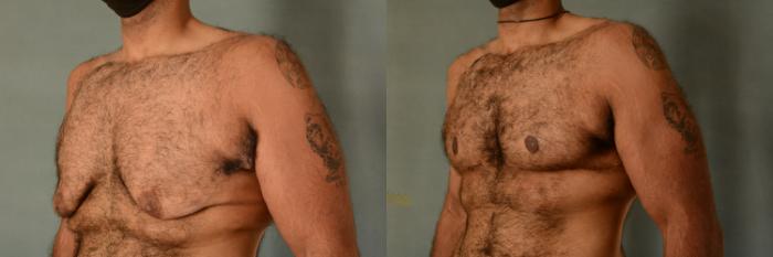 Before & After Gynecomastia (Male Breast Reduction) Case 404 View #2 View in Tallahassee, FL