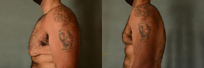 Before & After Gynecomastia (Male Breast Reduction) Case 404 View #3 View in Tallahassee, FL