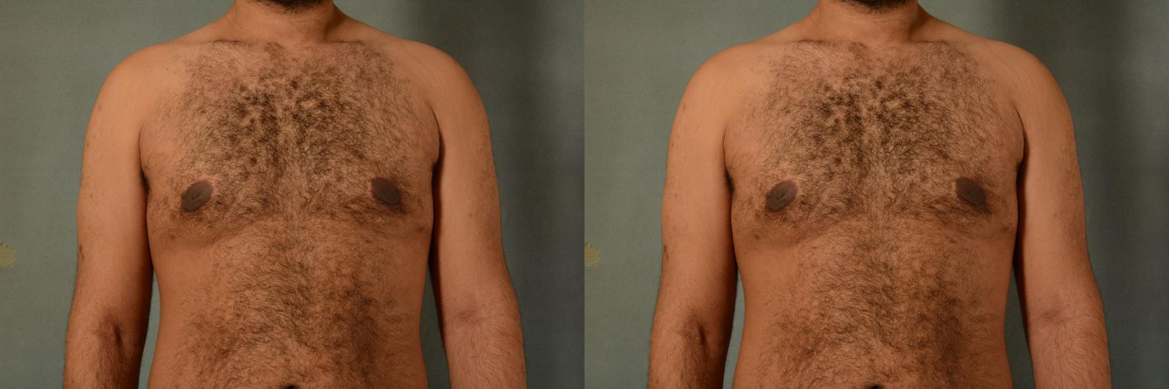 Before & After Gynecomastia (Male Breast Reduction) Case 419 View #1 View in Tallahassee, FL