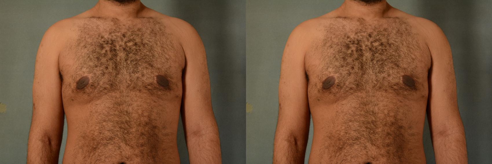 Pictures  Process  Sage Laser Tattoo Removal