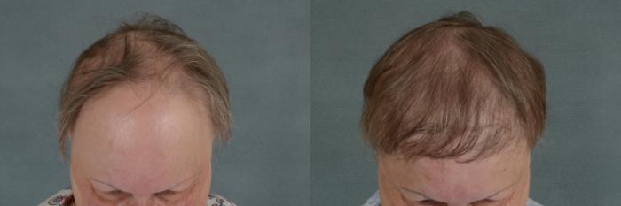 Before & After Hair Restoration Case 331 View #2 View in Tallahassee, FL