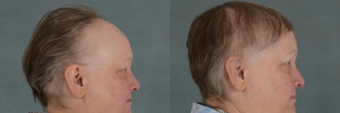 Before & After Hair Restoration Case 331 View #3 View in Tallahassee, FL