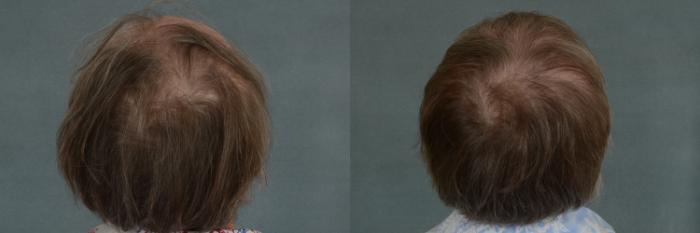 Before & After Hair Restoration Case 331 View #4 View in Tallahassee, FL