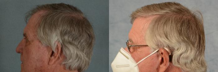 Before & After Hair Restoration Case 456 Left Side View in Tallahassee, FL