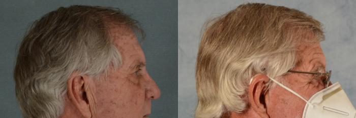 Before & After Hair Restoration Case 456 Right Side View in Tallahassee, FL