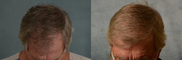 Before & After Hair Restoration Case 456 Top View in Tallahassee, FL
