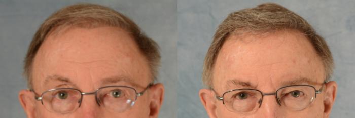 Before & After Hair Restoration Case 542 Front View in Tallahassee, FL