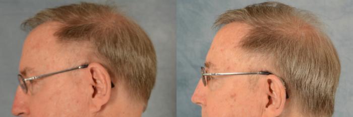 Before & After Hair Restoration Case 542 Left Side View in Tallahassee, FL