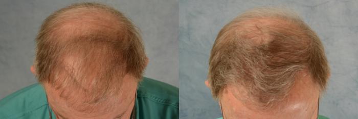 Before & After Hair Restoration Case 542 Top View in Tallahassee, FL