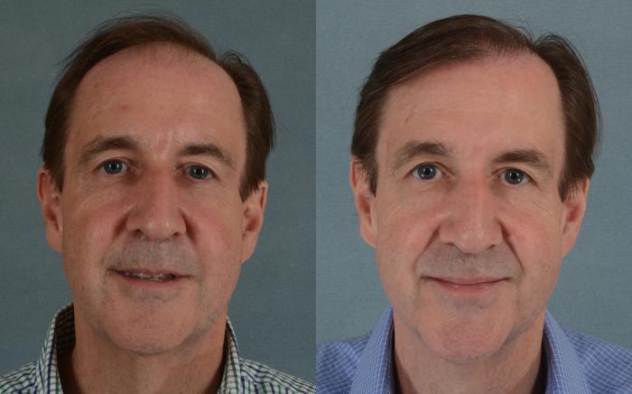 Before & After Hair Restoration Case 57 View #1 View in Tallahassee, FL